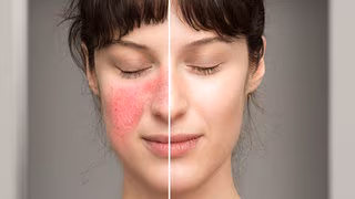 Rosacea: Was hilft gegen die Gesichtsröte?
