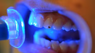 Strahlend weiße Zähne durch Bleaching: trendy, notwendig oder gefährlich?