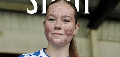 Wegen ihrer Akne wird diese 16-Jährige massiv angefeindet