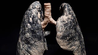 Lungen-CT f&uuml;r Starkraucher ab sofort kostenlos